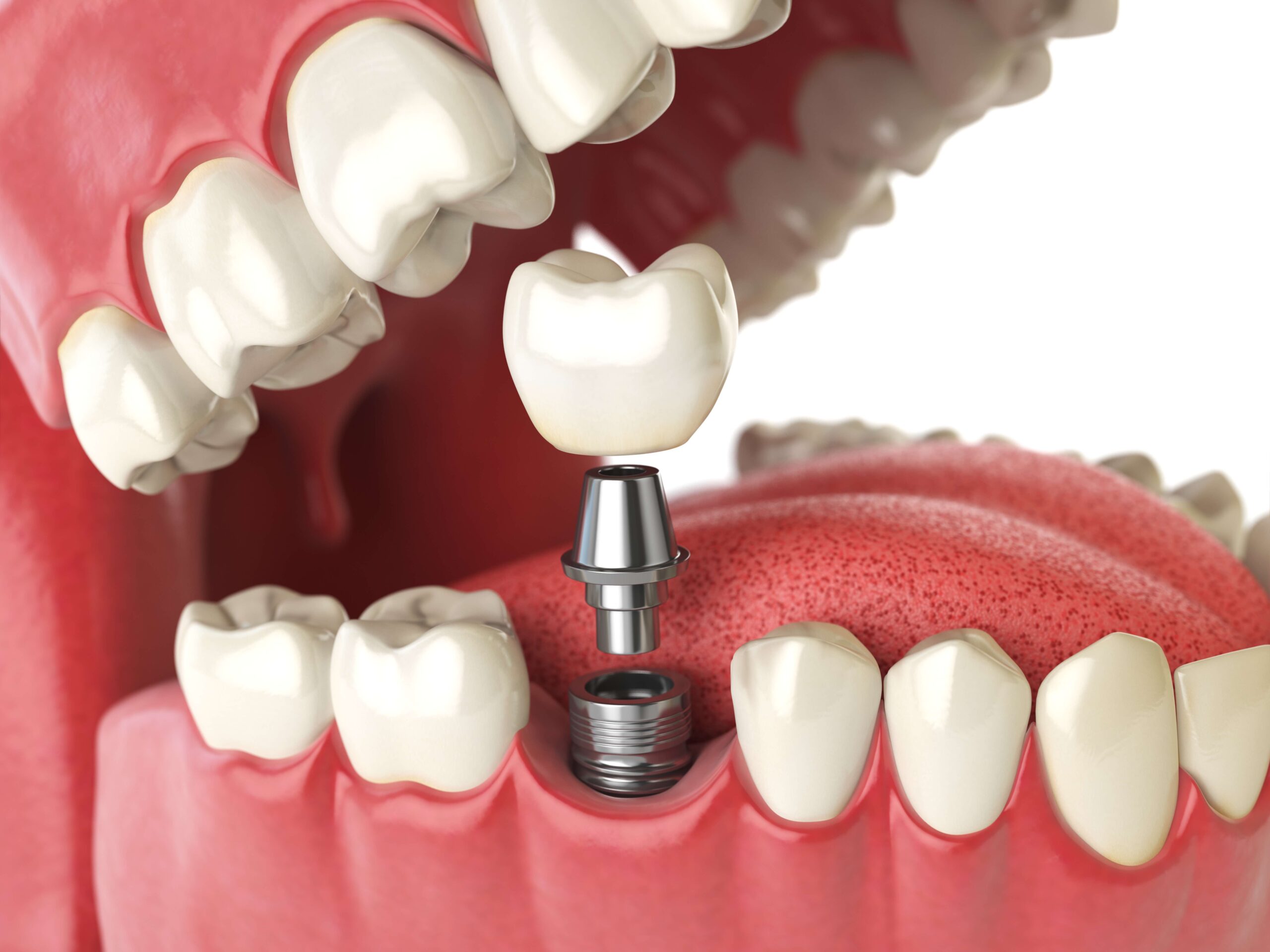 Implante dentário unitário