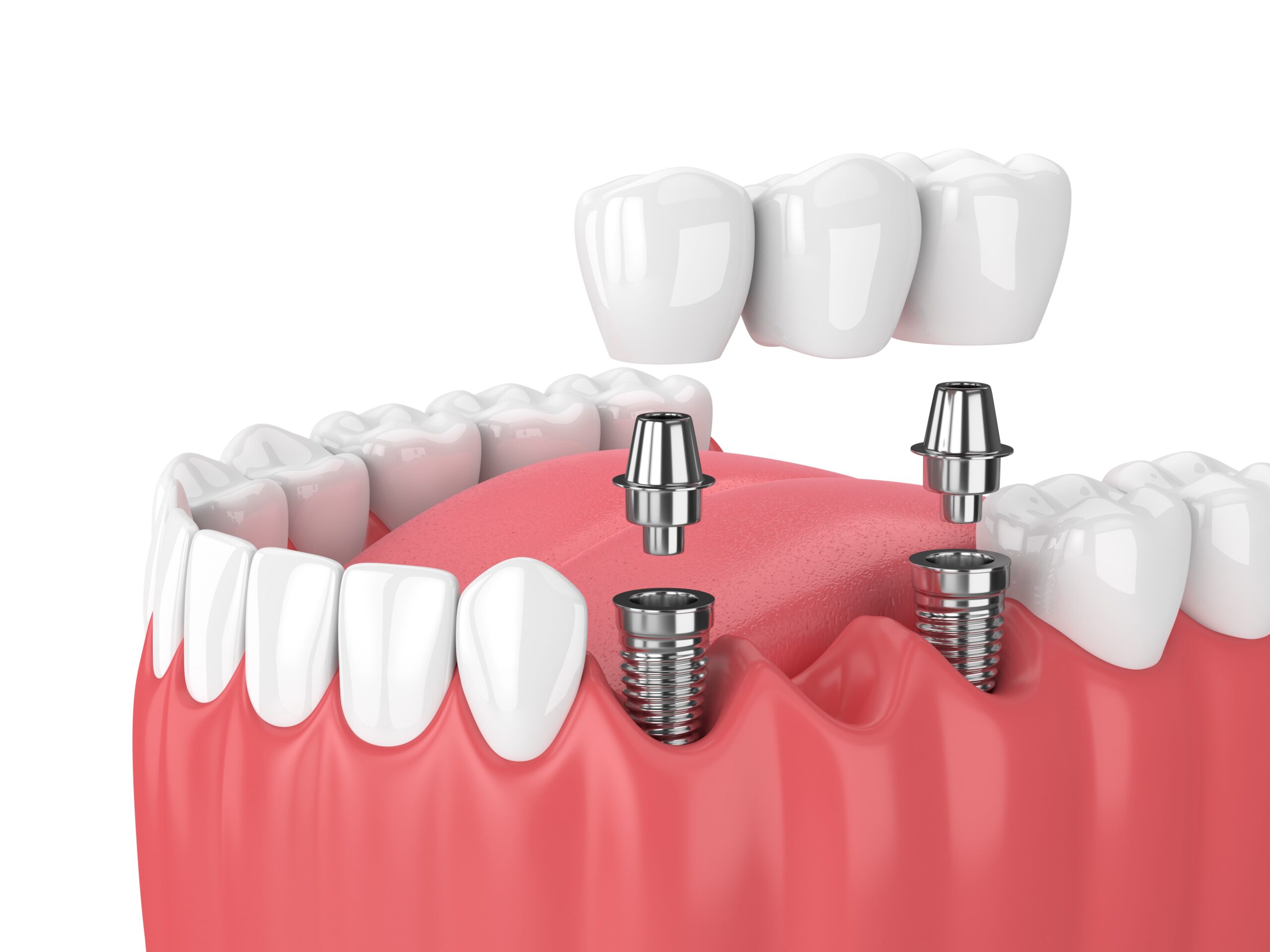 Implante dentário