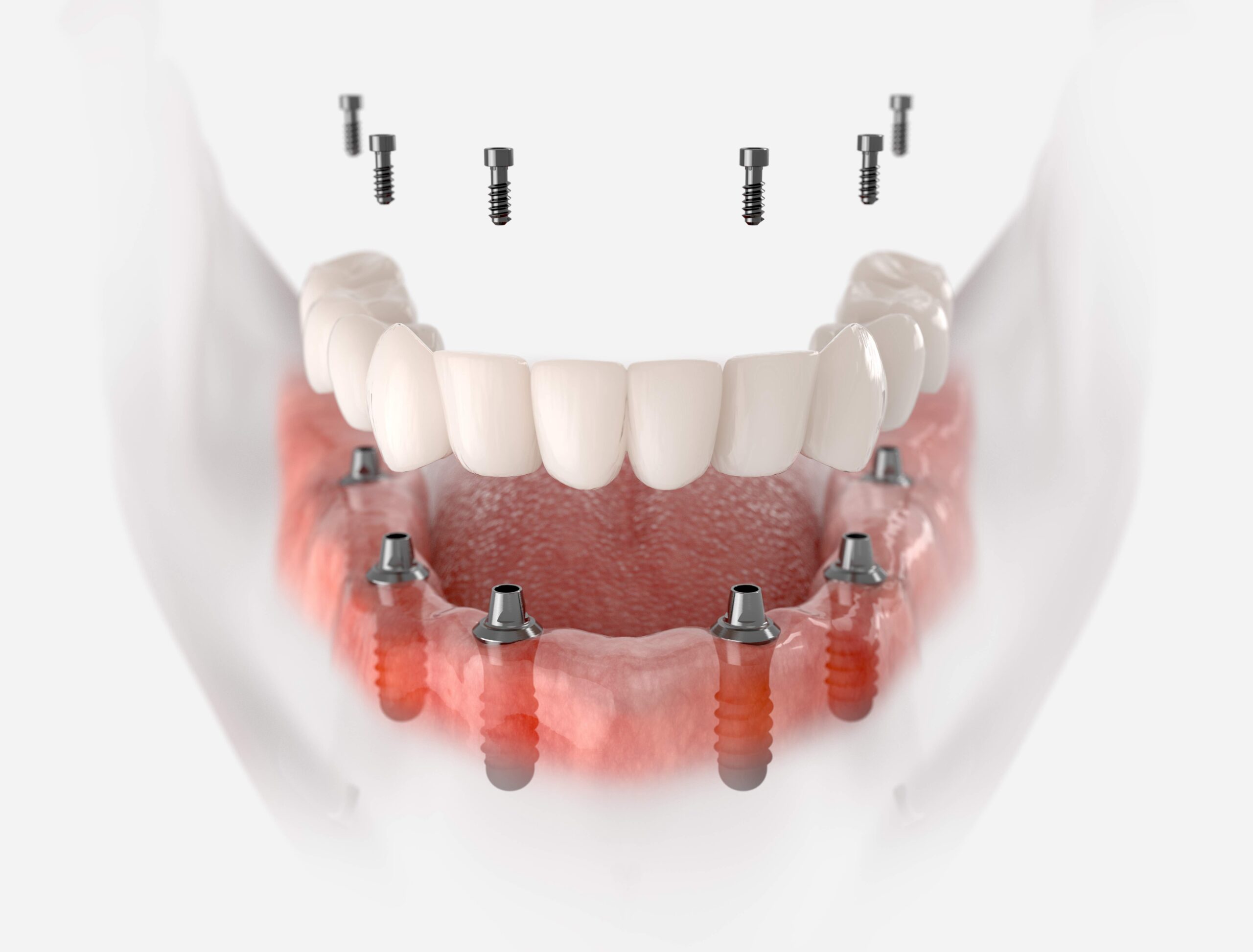 Implante dentario