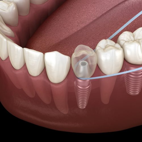 higienizar implante dentário